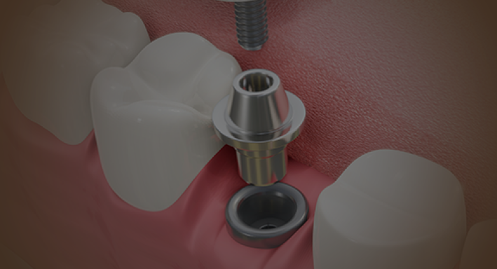 dental-implant dental-implant
